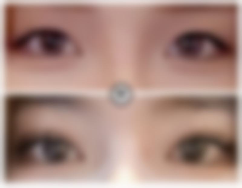 疤痕体质顺生的应对措施