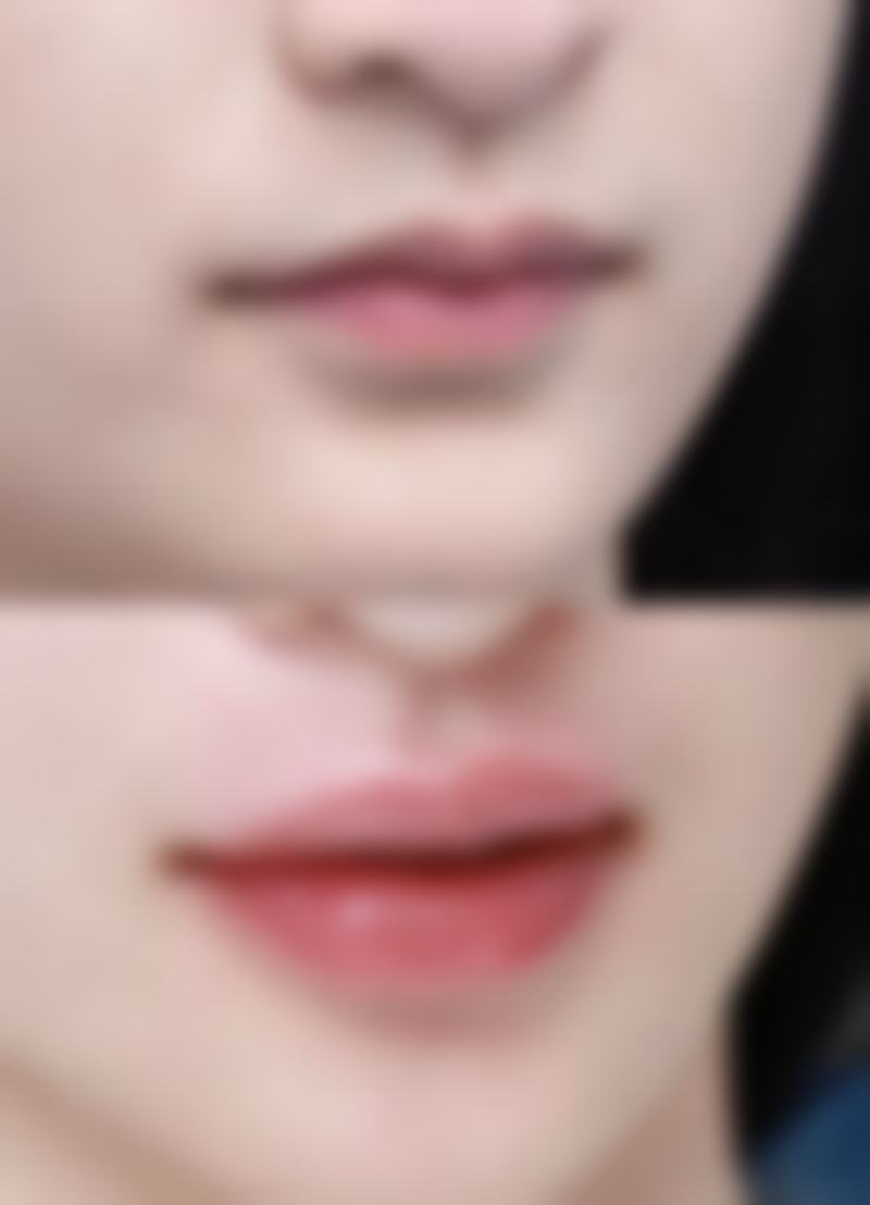 日常护理辅助去除被指甲抓成的疤痕