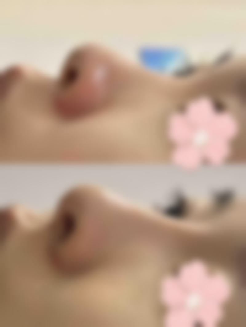 哪些人适合注射除皱针