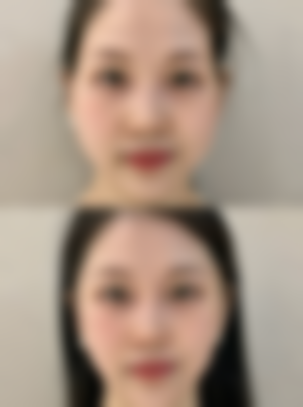 如何让隆鼻硅胶放置时间更久