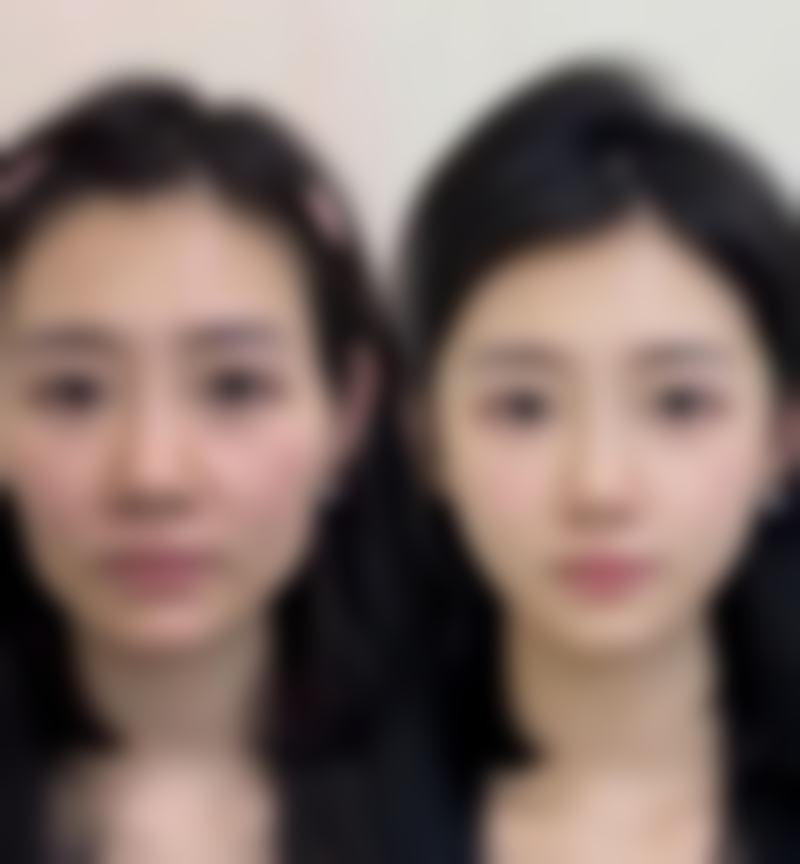 化学剥脱解决脸上起痘痘留下的疤痕怎么办
