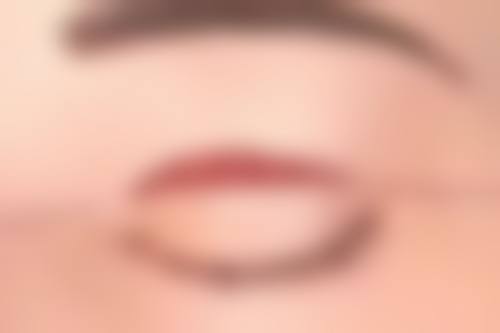 影响隆鼻拆线时间的因素有哪些