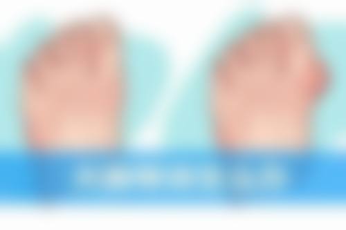 做完纳米无痕双眼皮可以吃清淡易消化的食物