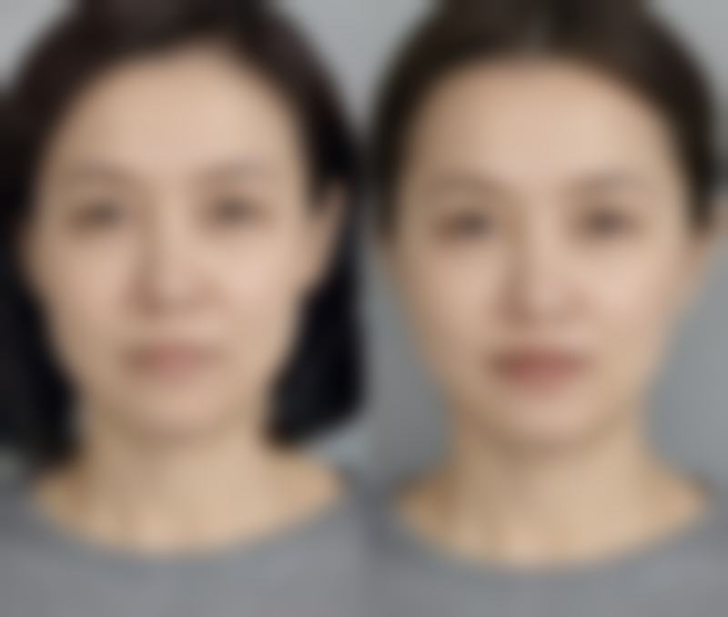 隆鼻拆线前后需要注意什么