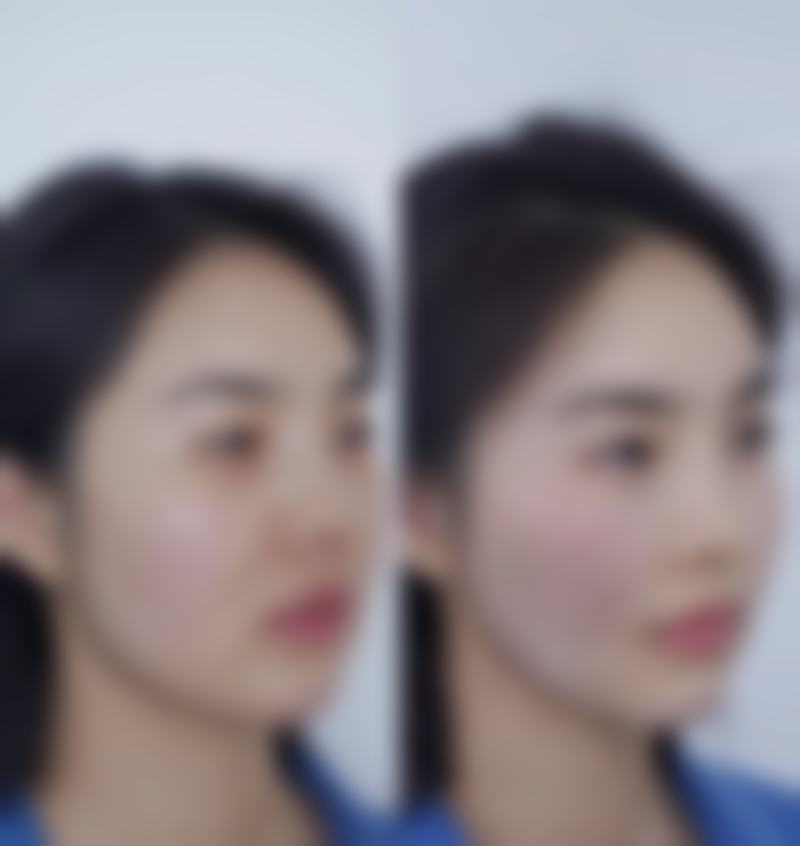 不同类型的烫伤疤痕及修复情况