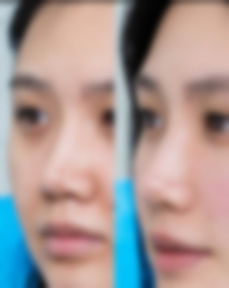 总结：割双眼皮割完就可以睁眼吗