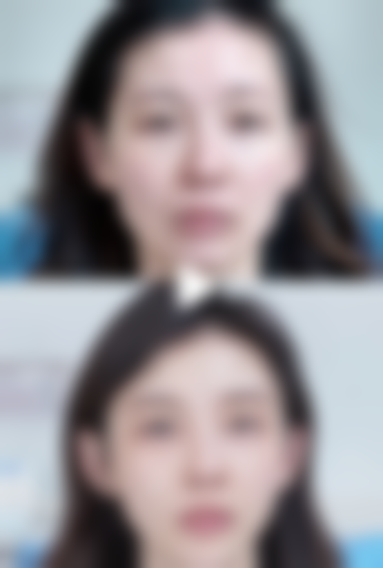 不同双眼皮手术方式对睁眼的影响