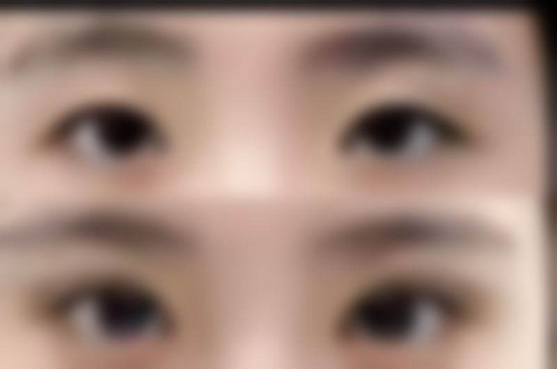 不同隆鼻方式对忌口时间的影响