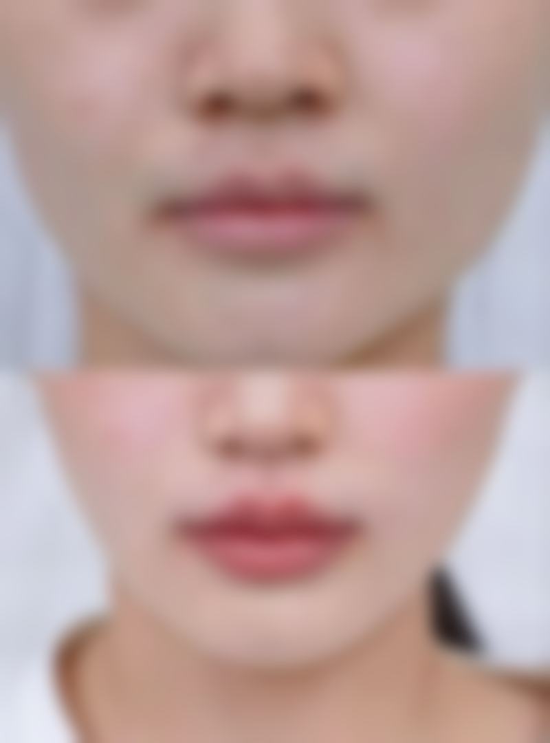 眼袋筋膜悬吊术的修复过程
