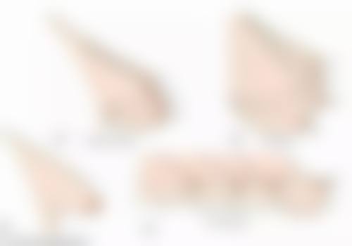 双眼皮处红肿痒痒是怎么回事？可能是过敏、炎症或术后反应等原因导致
