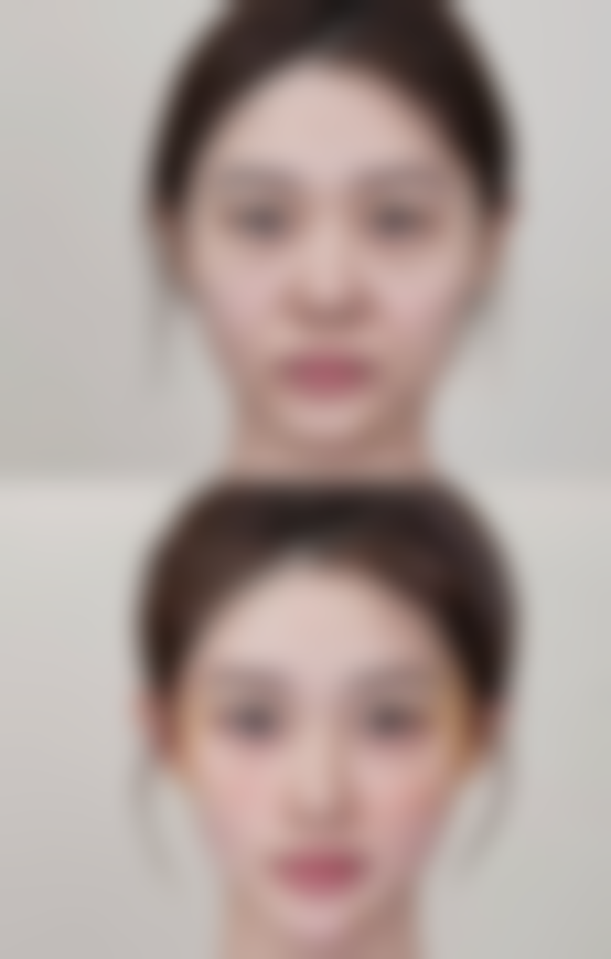 睑缘炎也会引起双眼皮处红肿痒痒