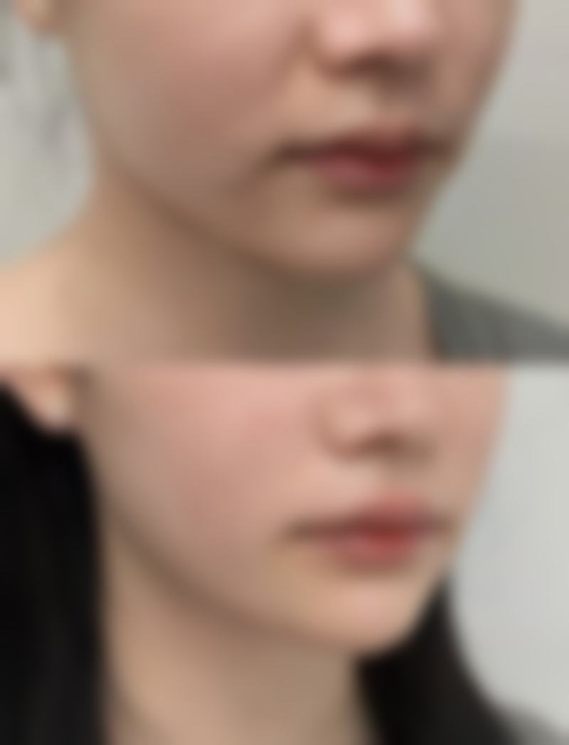 自己肚子脂肪抽来隆胸有风险吗