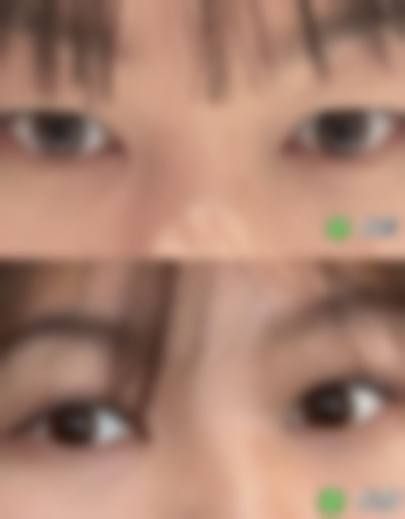 术后护理对祛眼袋手术修复期的影响