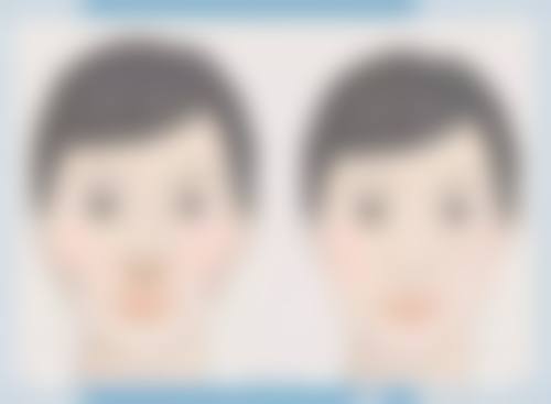 外切去眼袋后白色疤痕用激光去除的情况