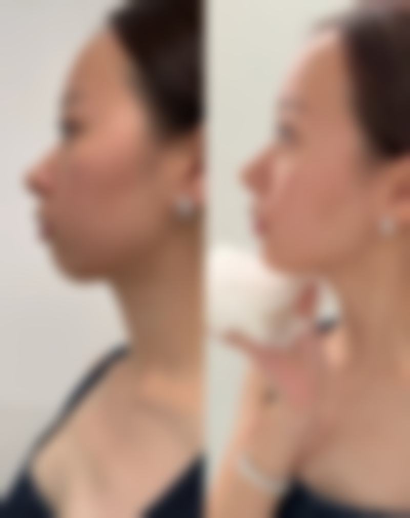 激光治疗白色疤痕的成效