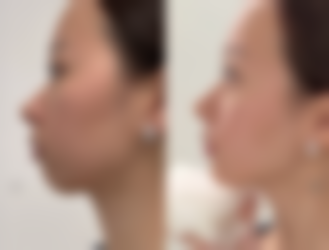 生活小妙招辅助去眼袋