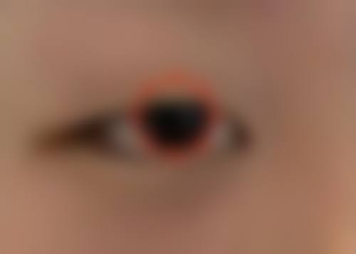 不同类型疤痕的治疗难度和成效