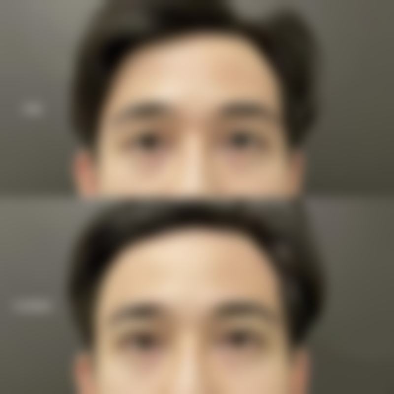 脸上的痘疤痕怎么去除？药物、激光、微针、手术及日常护理各有妙招