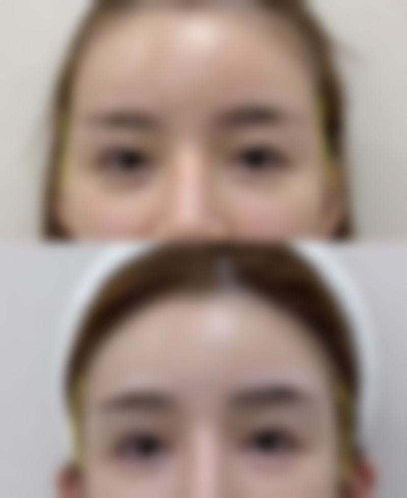 微针治疗去除痘疤痕
