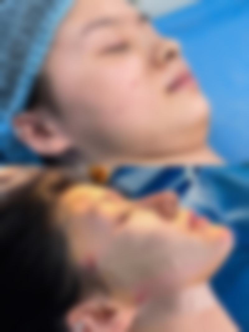 手术红疤痕多久能好因人而异