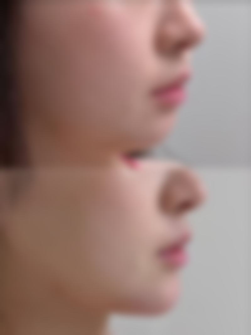 如何在疤痕修复期间避免抽烟