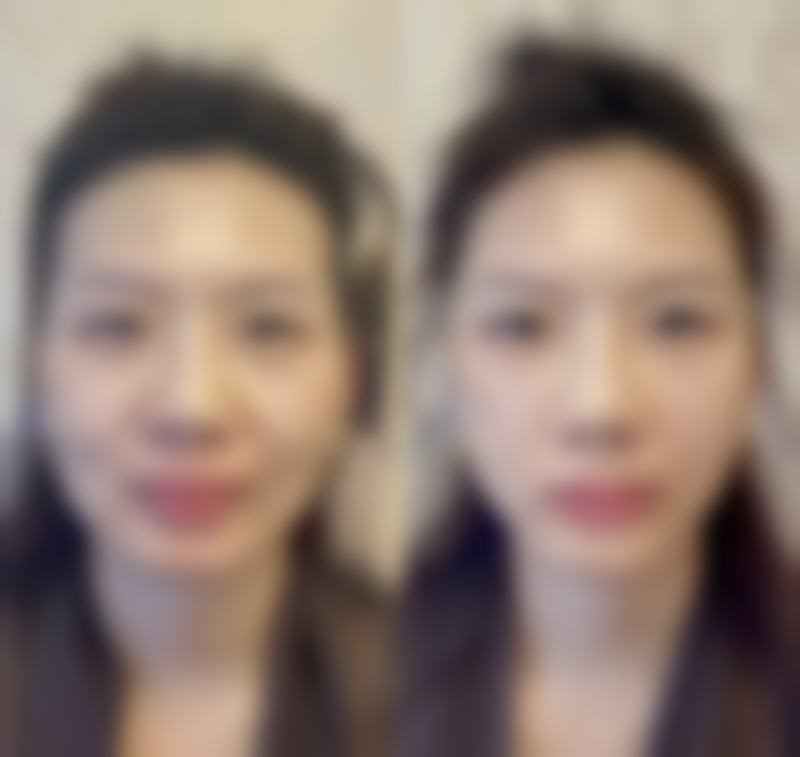 哪些人割双眼皮不开眼角也挺好