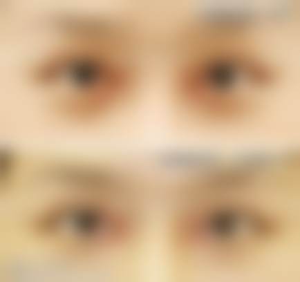 北京张冰洁医生眼修复临床实例多吗?
