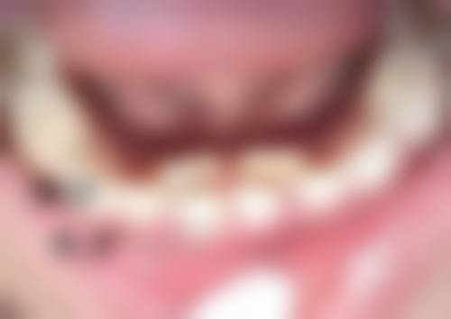 割双眼皮后眼屎多的处理方法