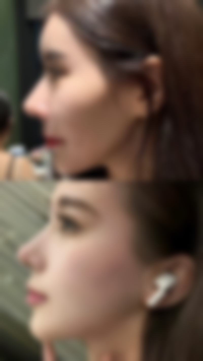 膨体材料：与组织紧密融合