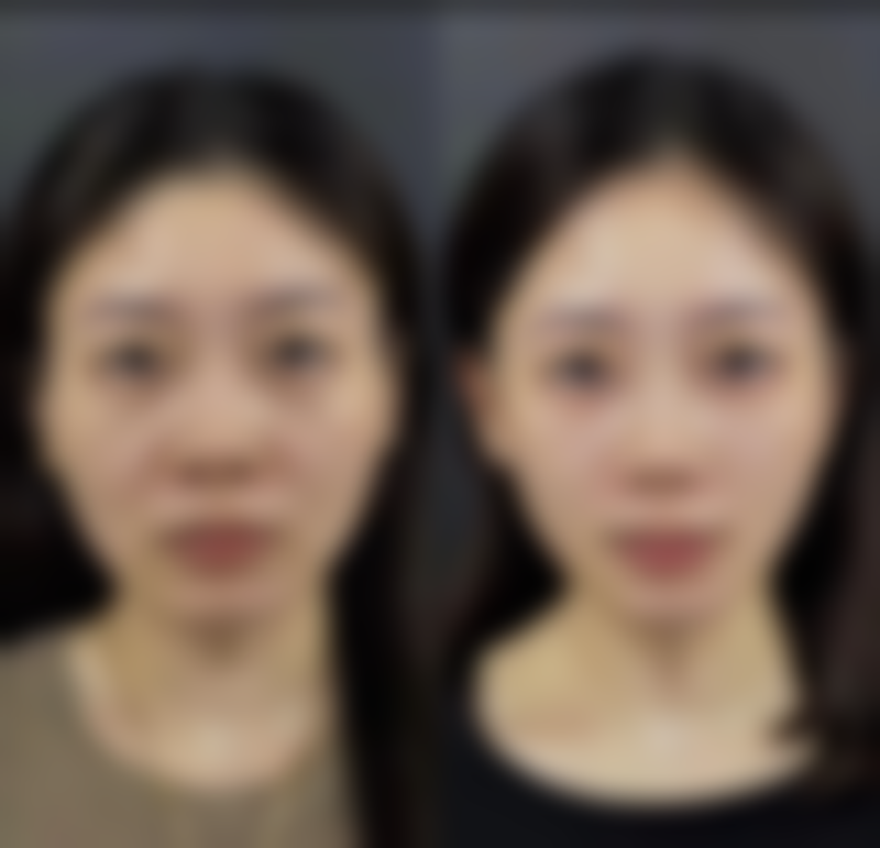 脸抽脂引发的皮肤凹凸不平后遗症