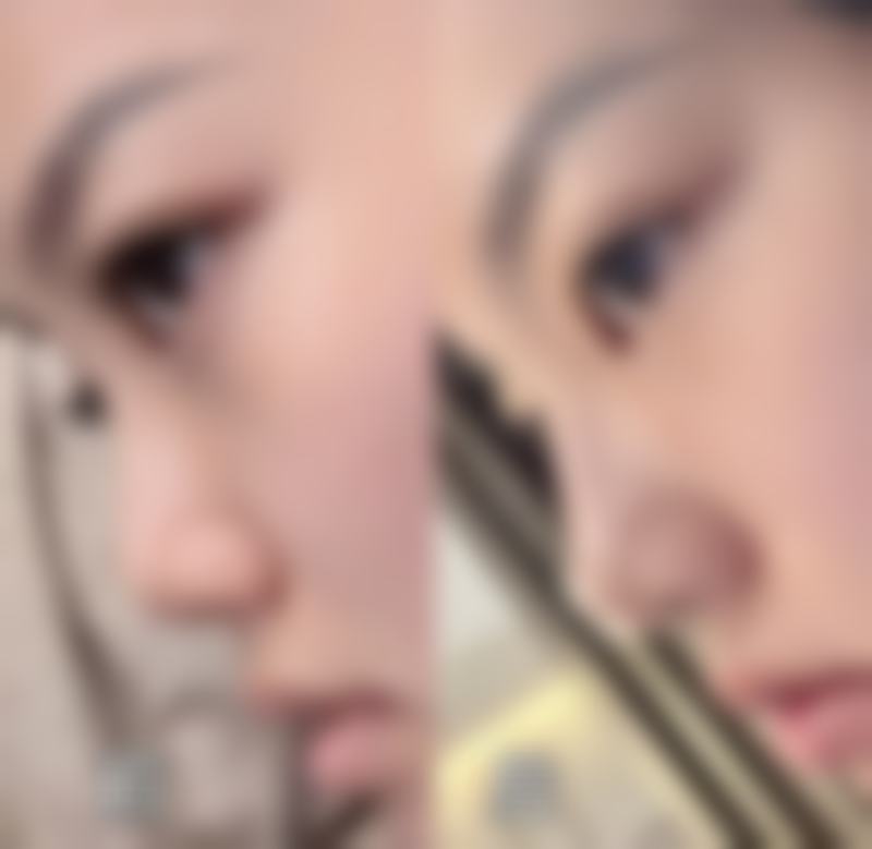 不同材料注射隆鼻的特点及价格情况