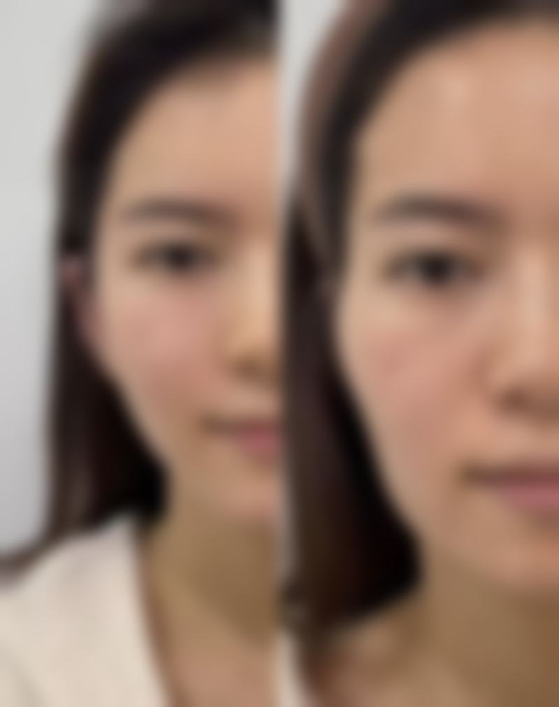 如何降低种植发的风险