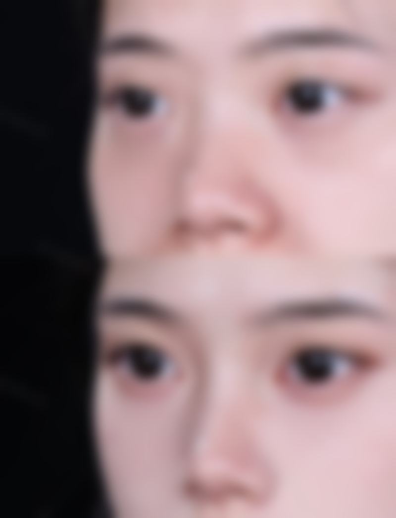 内切祛眼袋与吸脂法的对比