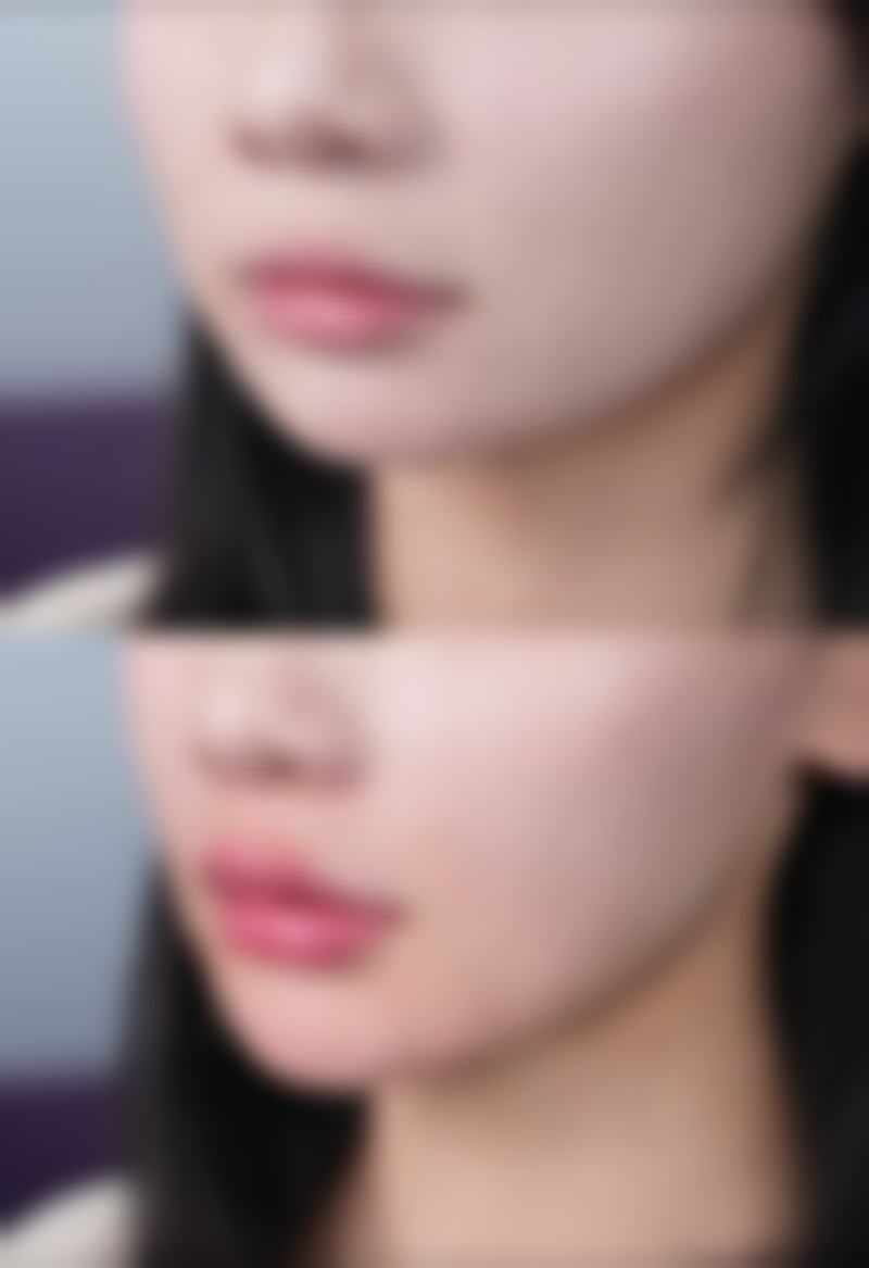 医美手段改善眼袋下面凹陷