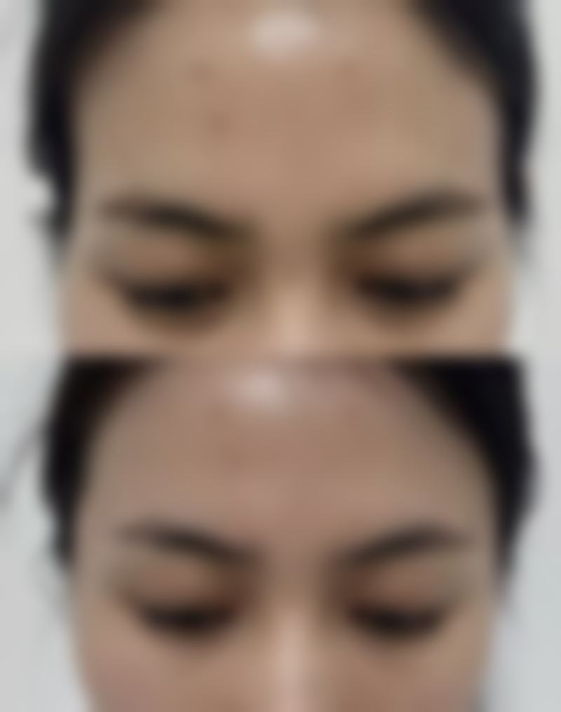哪些因素会影响环腹吸脂后反弹