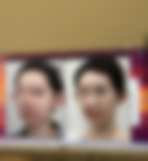 内双眼皮突然变外双是怎么回事？或是肿胀、松弛、遗传、外力、疾病等因素所致
