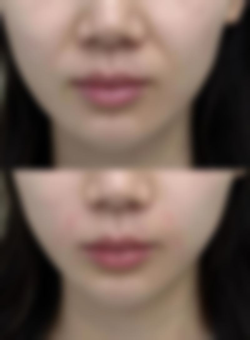 加速割了双眼皮后修复的方法
