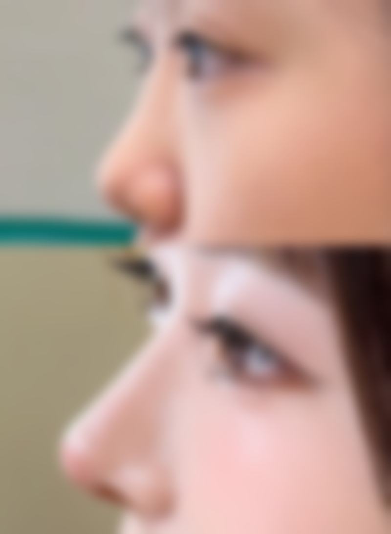 深度疤痕修复的注意事项
