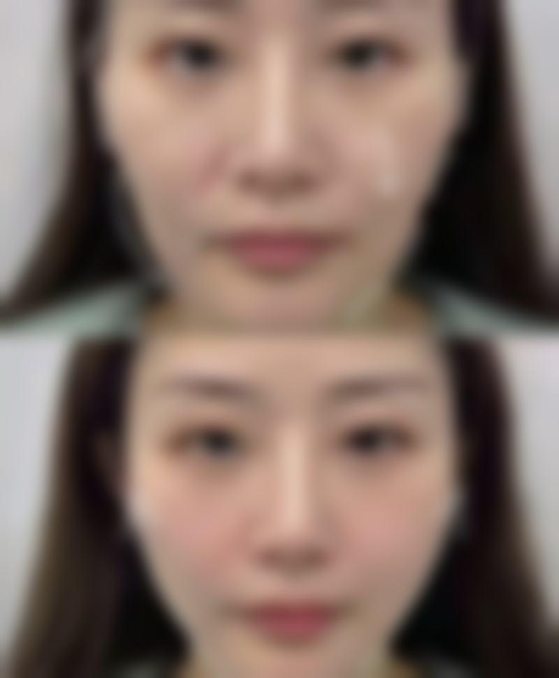 年龄增长怎样促使眼袋形成