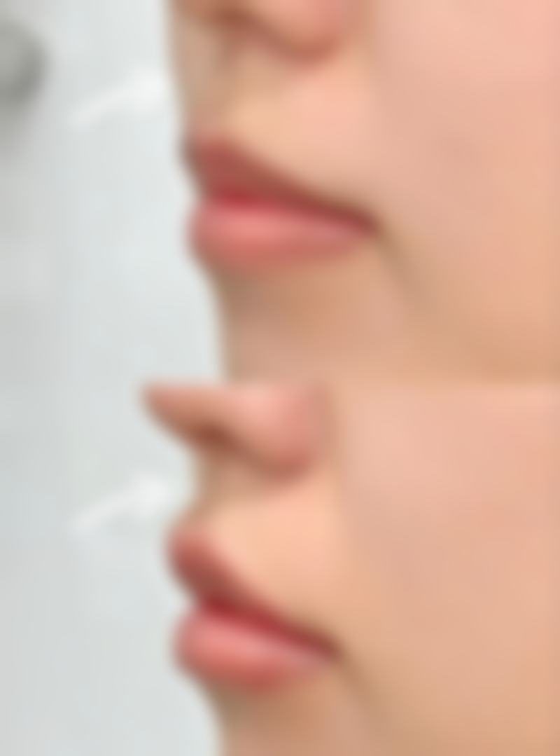 如何避免环腹吸脂后反弹