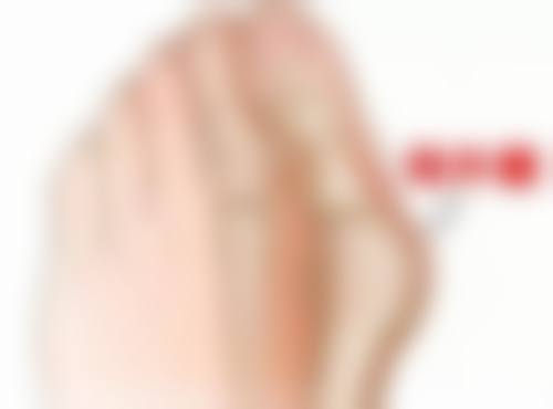 不同类型疤痕增生的情况