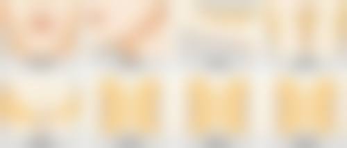 外切眼袋手术后多久可以完全恢复？一般1 - 3个月，哪些因素会影响恢复时间呢