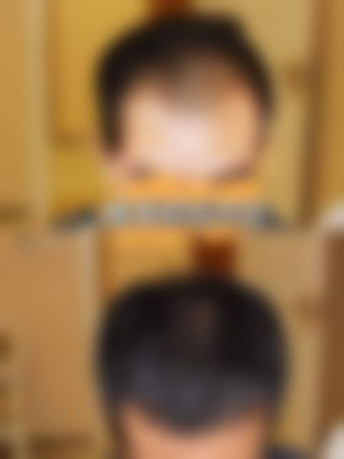 杭州百年植发口碑如何?