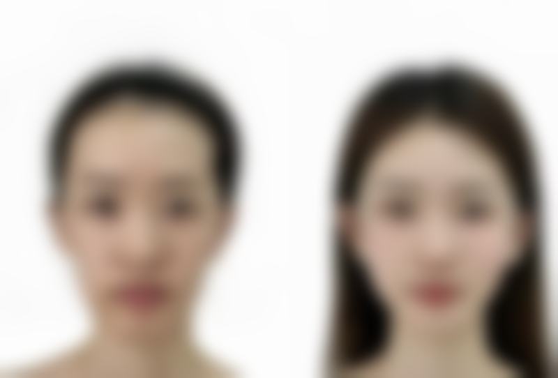 有种植发际线的吗？了解原因、原理、技术、价格及机构选择要点