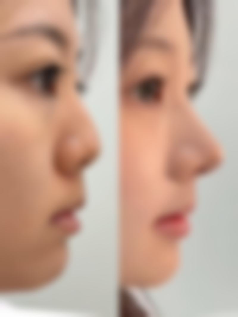 疤痕可以涂抹芦荟胶吗？不同类型疤痕有何差异又该注意啥
