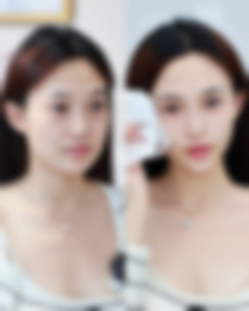 硅酮类药膏在痘坑疤痕修复中有什么优势