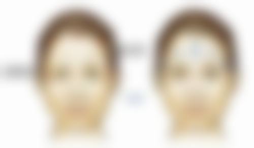 手术方式选择不当造成割完双眼皮眼睛没有变大