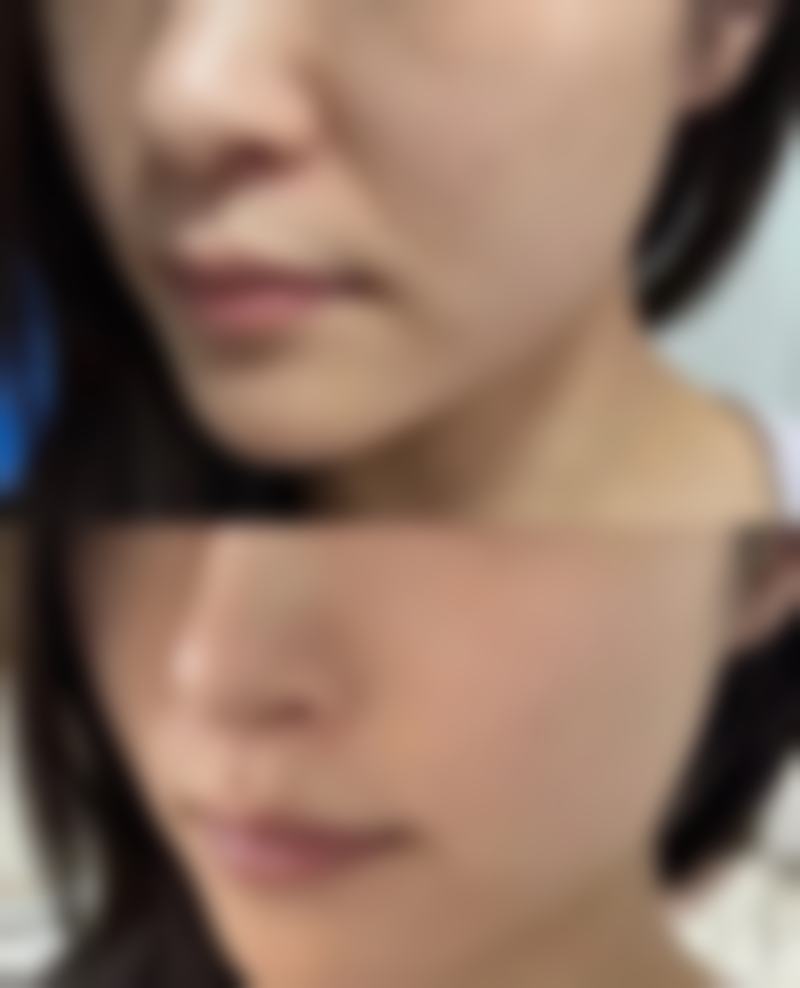 药物辅助减少留疤