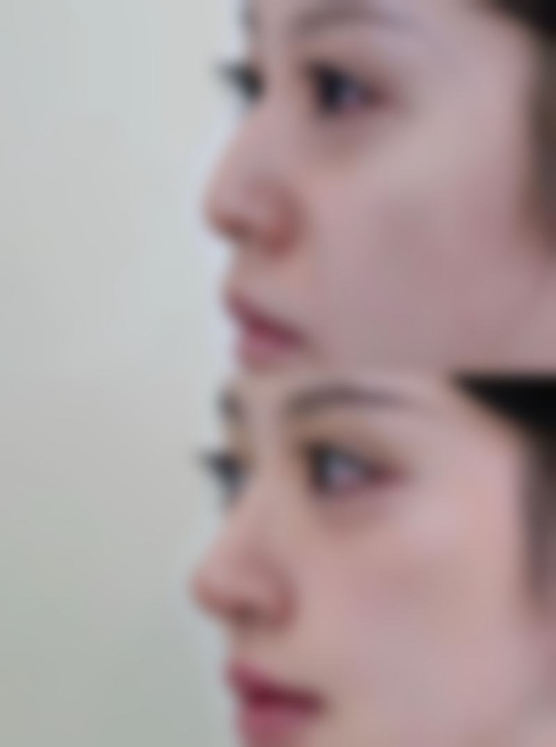 手术切除去除疤痕疙瘩