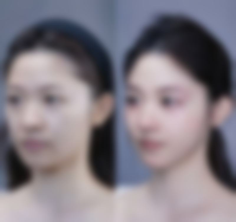 jj毛发移植收费标准参考
